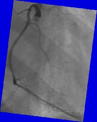 Right Coronary Artery