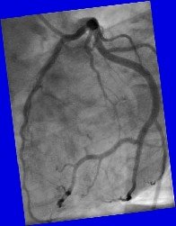 Left Coronary Artery