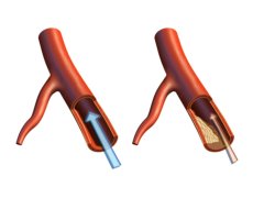 Blocked Arteries or Atherosclerosis